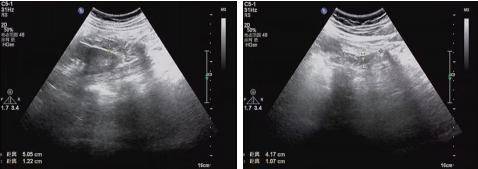 穿刺引流术后第48天复查腹部b超 双侧腰大肌前方低回声区 考虑积液