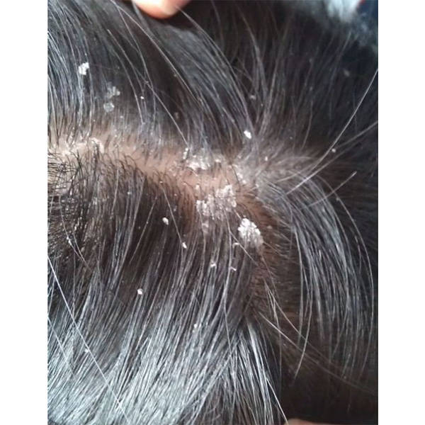 男士毛囊炎用什么洗发水