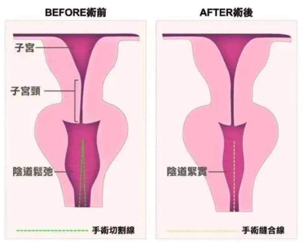 女性阴壁膨出症状图片