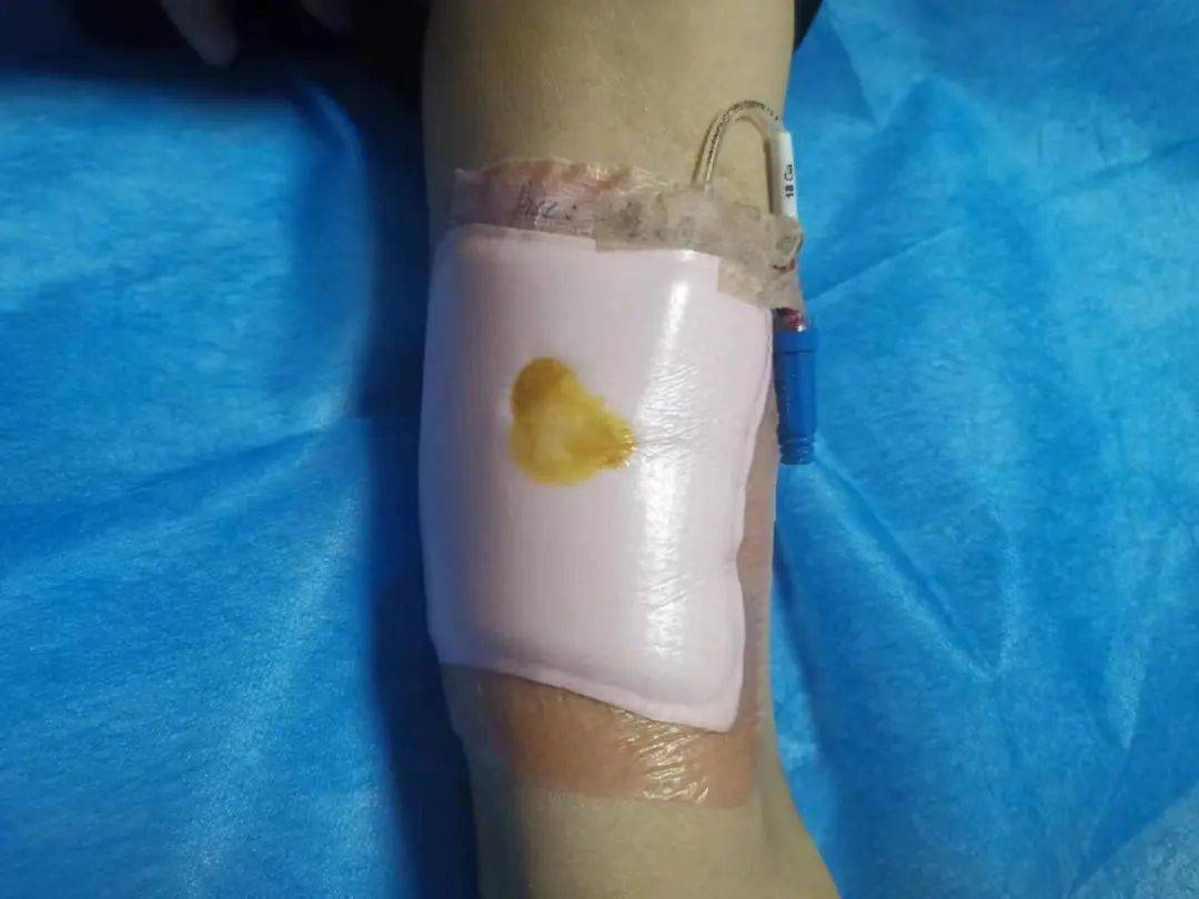 宁津县中医院刘金荣成功为picc淋巴液渗漏患者护理获好评