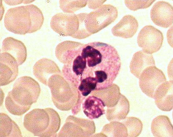 中性粒细胞中含有包涵体,多为云雾状蓝斑,形状多不规则,分布在胞质及