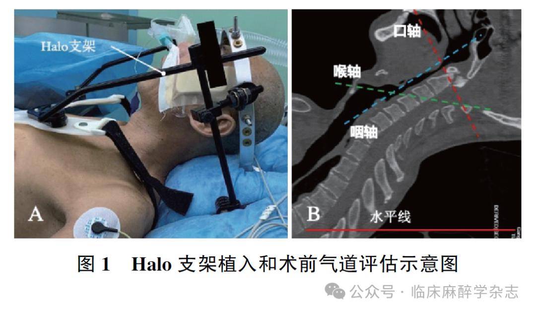病例报道 | 寰枢椎骨折halo支架植入患者清醒气管插管气道局部麻醉一