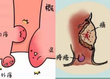 屁股长痔疮图片的症状图片