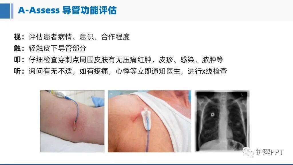 cvc维护-冲管与封管_chenxi_微信_来源