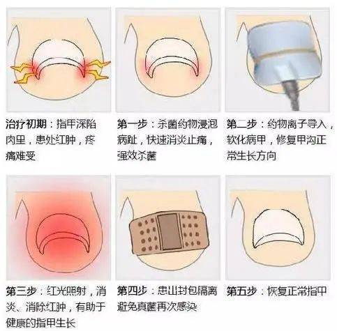 甲沟炎自己怎么剪图解图片