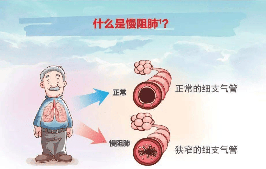 这些"肺"话,我们不得不说!_锻炼_患者_治疗