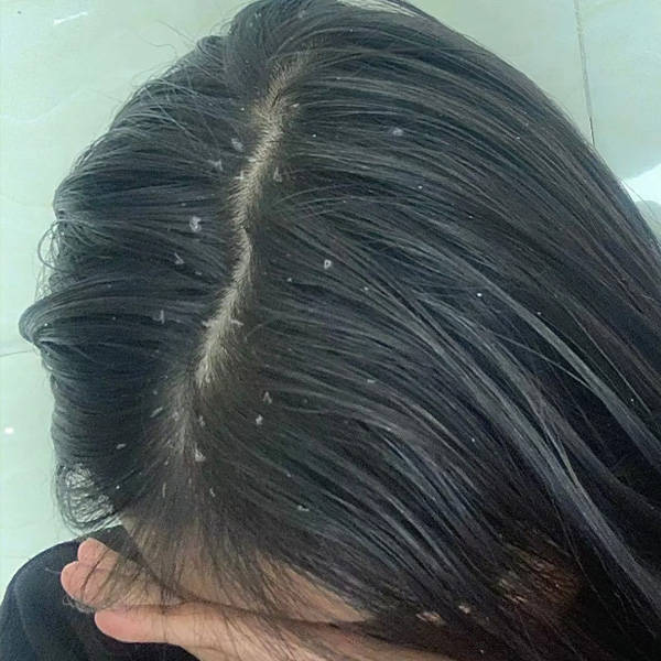 治头皮屑的洗发水有哪些止痒最好的洗发水推荐