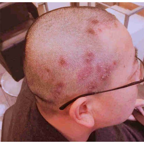 好多头皮屑用什么洗发水去头屑效果最好的洗发水推荐