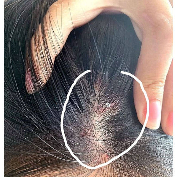 头皮头痒头屑多用什么洗发水