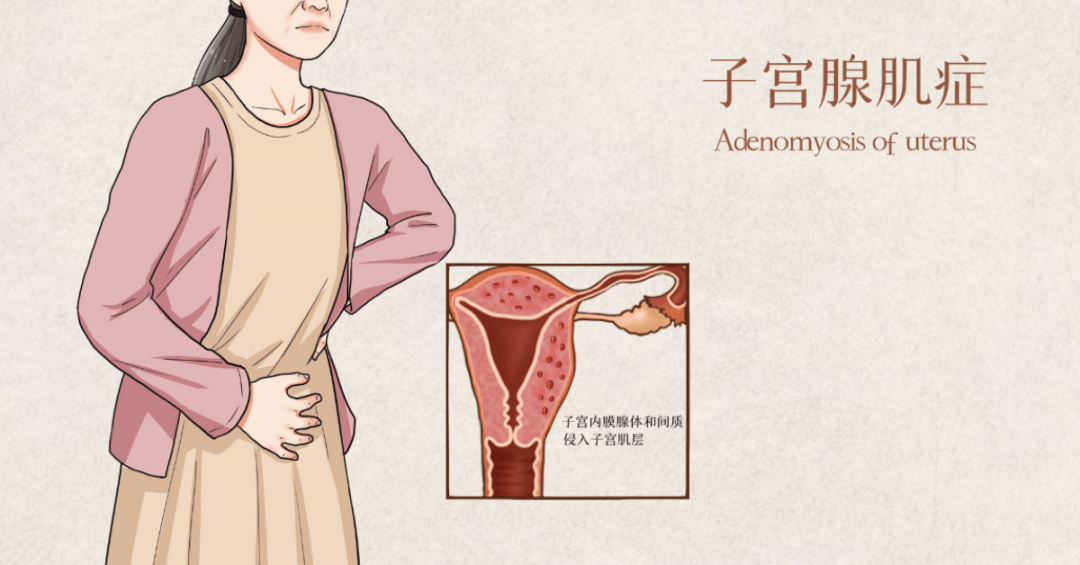 子宫_内膜_肌瘤