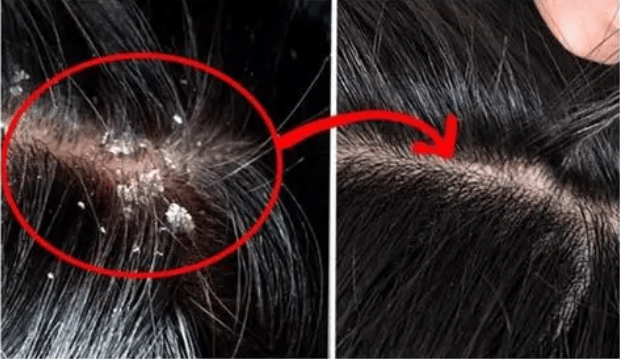 去屑止痒的洗发水排行榜_头皮_头发_问题