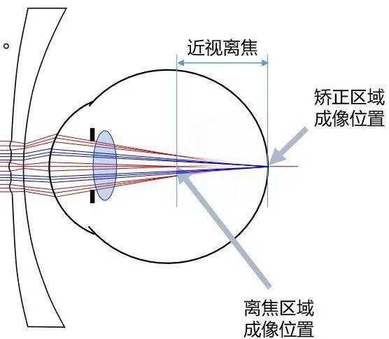 近视与眼轴生长密切相关!_视网膜_孩子_角膜