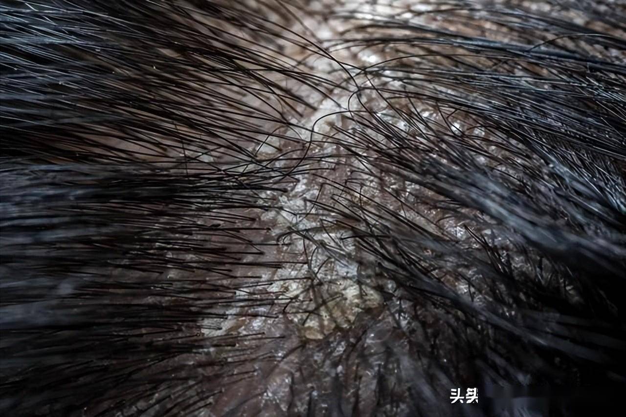 为什么你的头皮屑变多了？医生：头皮屑多通常由这3个原因导致