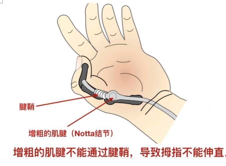 屈肌腱鞘炎图片