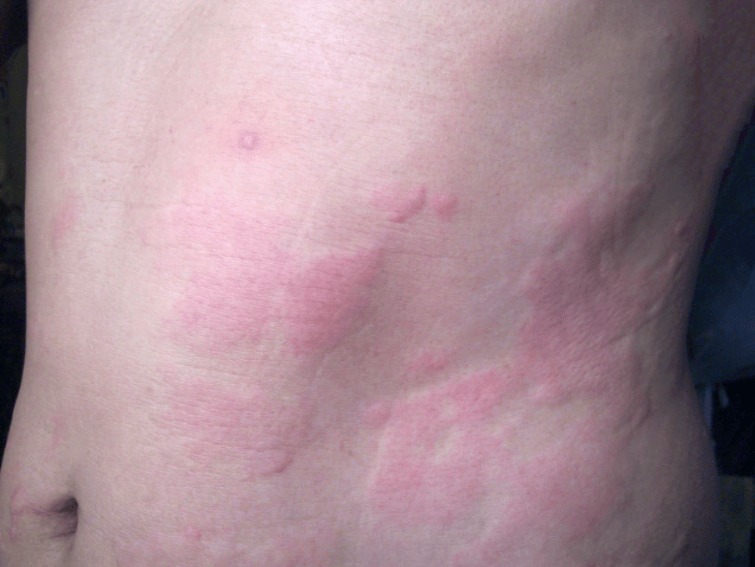 荨麻疹可能是哪些皮肤病导致的?