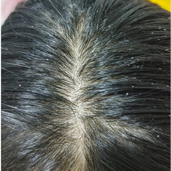 头皮很痒买什么洗发水去屑洗发水排行榜