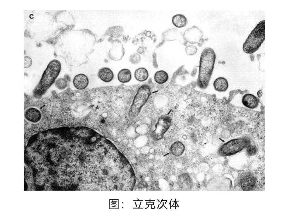 出院前复查显示,患者脑脊液内猫立克次体为阴性,头痛