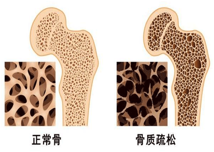 防治骨质疏松