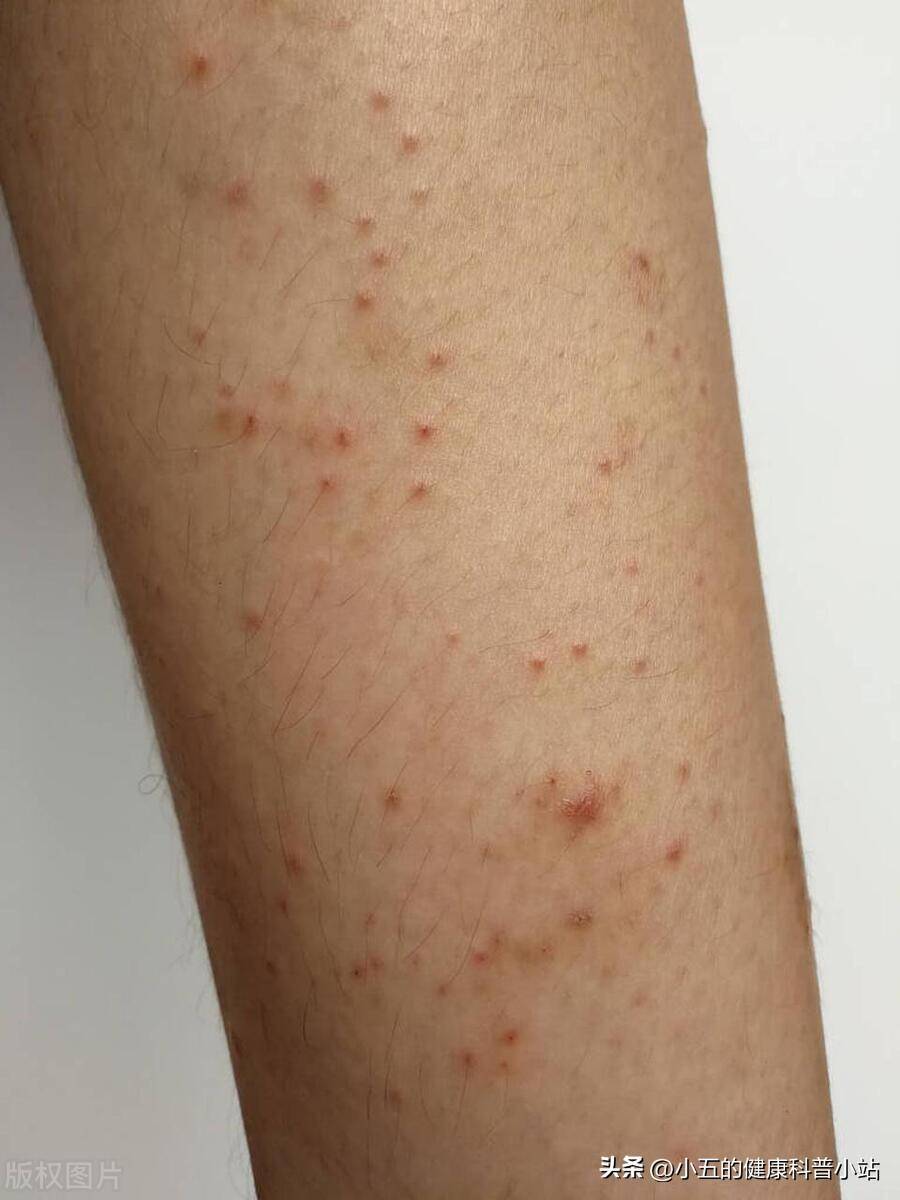慢性荨麻疹会自愈吗图片