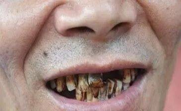 槟榔的粗纤维对牙齿造成严重磨损,加上槟榔碱,石灰对牙周组织的刺激变