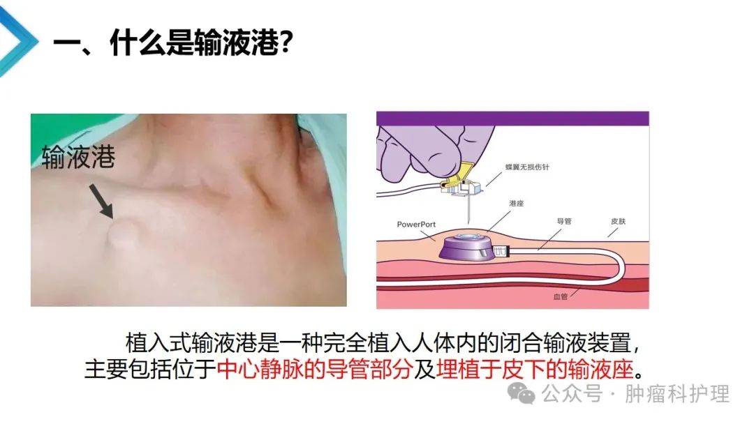 输液港多久维护一次图片