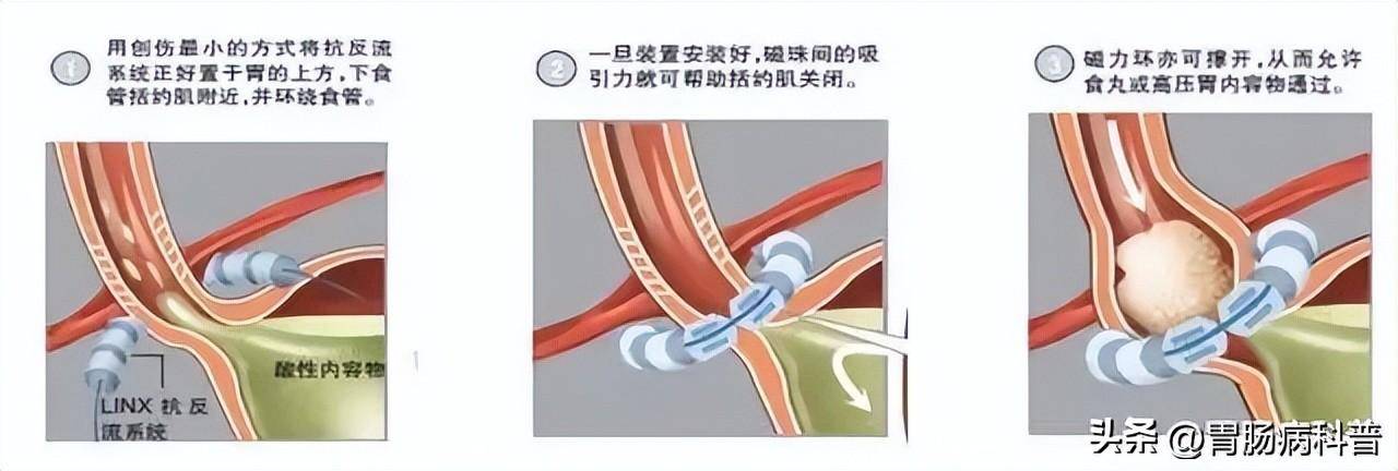 六,内镜下贲门紧缩术内镜下贲门紧缩术是利用套扎器,一次性均匀间断的