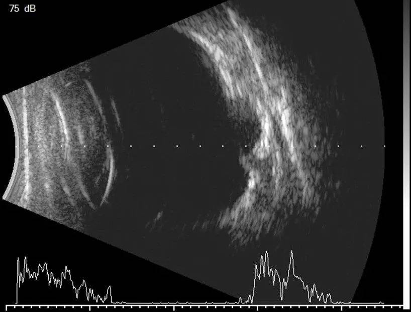 带您了解眼部b超