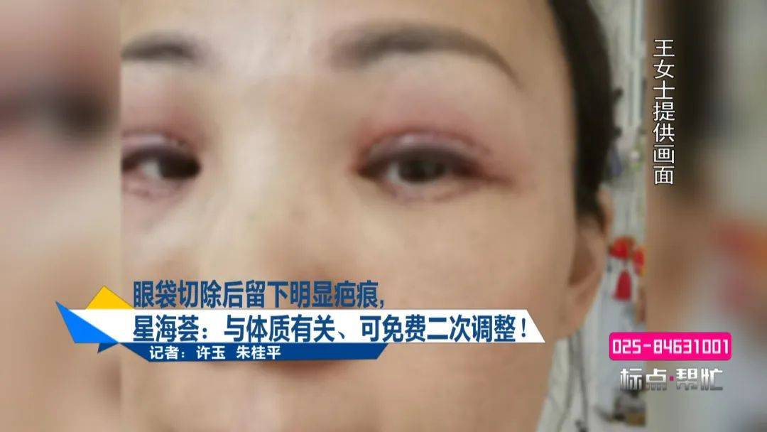 女子切除眼袋后留下明显疤痕 星海荟医疗美容院:与体质有关(图3)