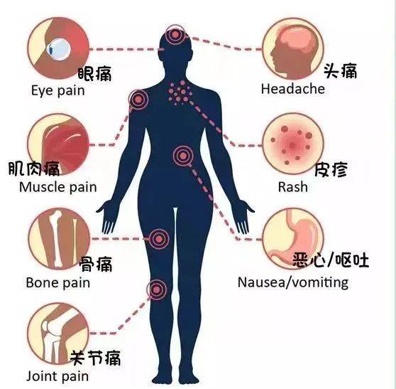 典型症状是发烧,头痛和关节痛等,感染登革热轻则突然发热,剧烈肌肉