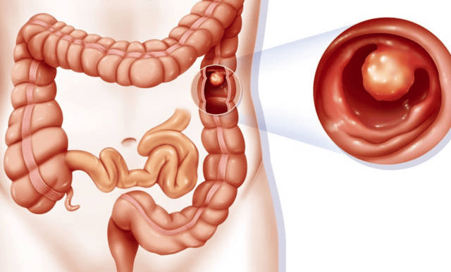 早期结直肠癌缺乏典型临床表现,仅仅表现为大便潜血阳性