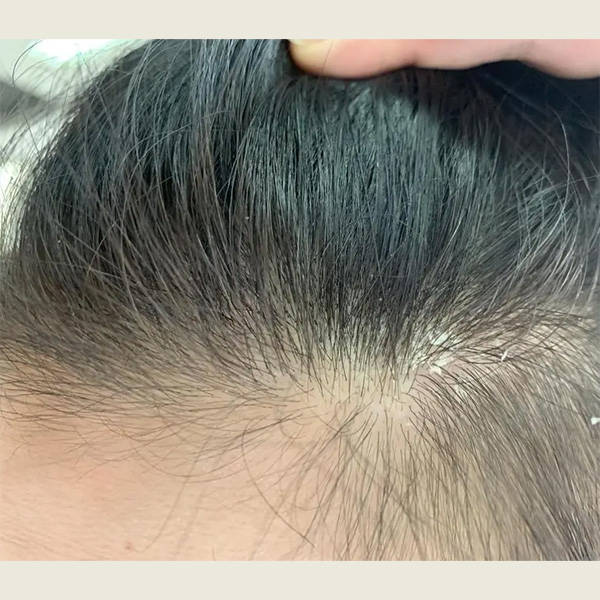 头皮屑很严重用什么洗发水好去屑止痒最好的洗发水推荐