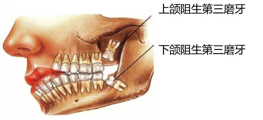 尽头牙位置图片