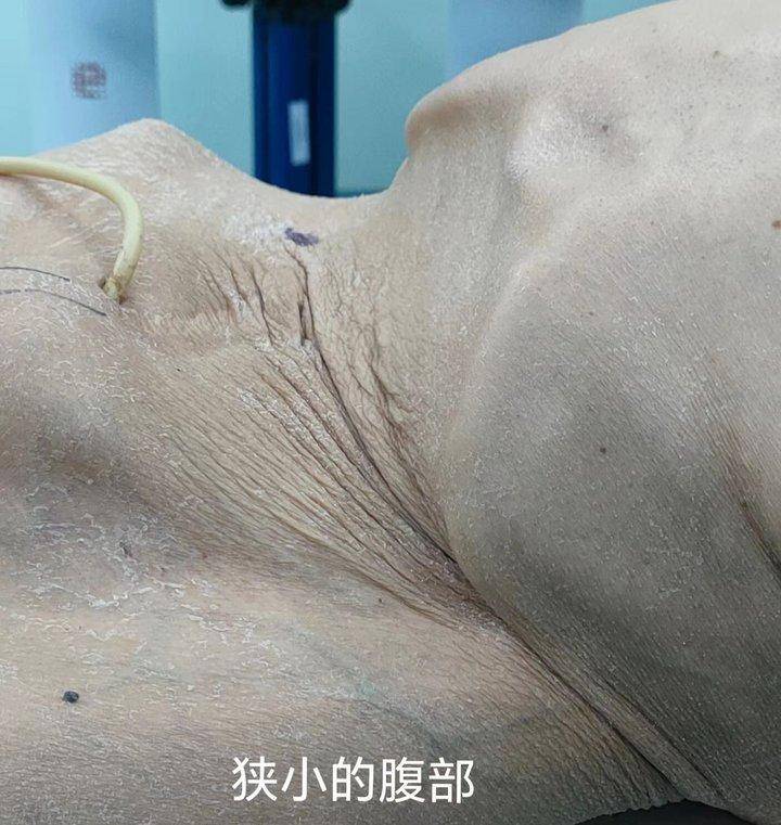 身高一米二,脊柱严重侧弯……青大附院杨学成团队为患者完成复杂膀胱