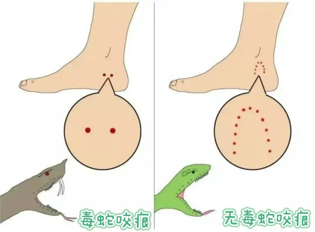 最近被蛇咬伤送医的有点多,原因是…_救治_伤口_毒蛇