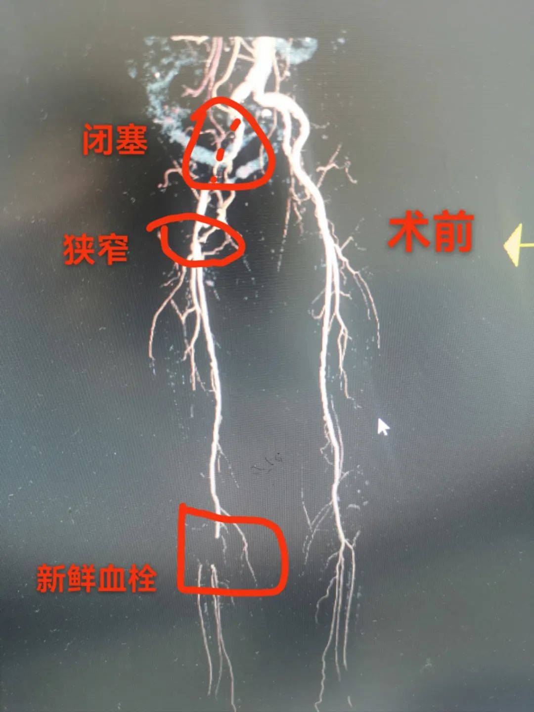 "鱼"与"熊掌"兼得:杂交手术小切口解决下肢动脉三处闭塞_血管_余