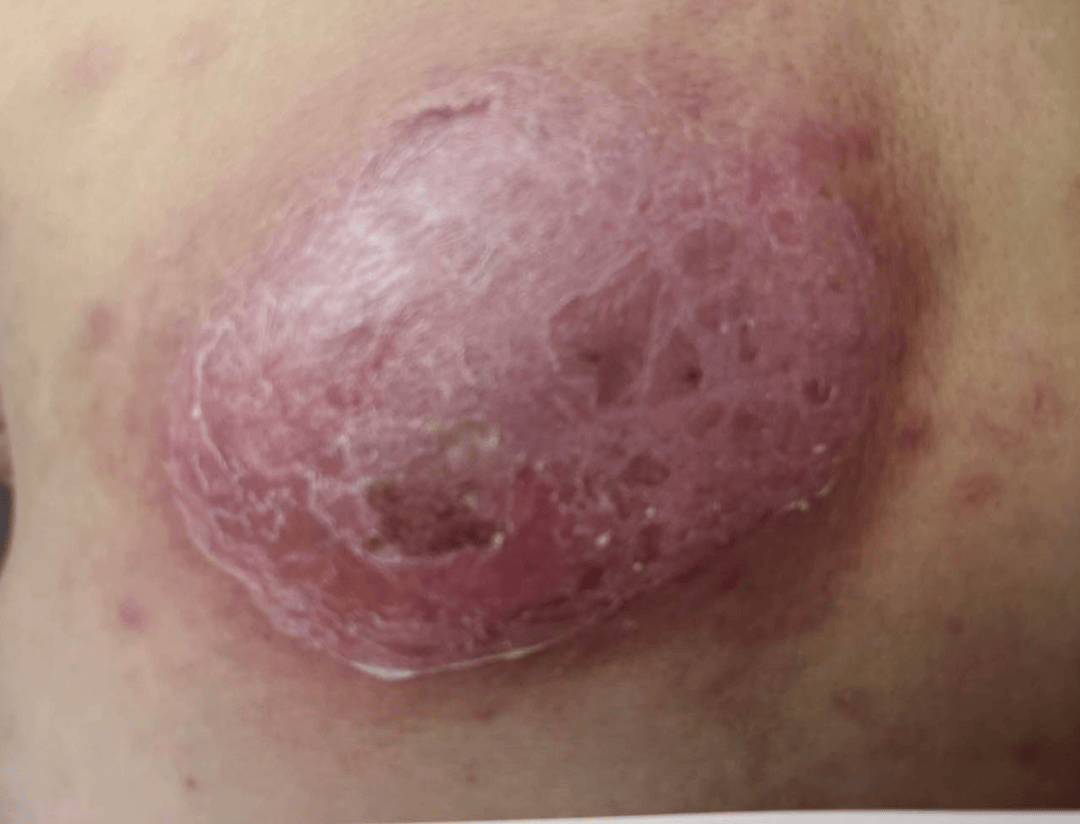 95959595959595959595疖和痈症状图片高能预警