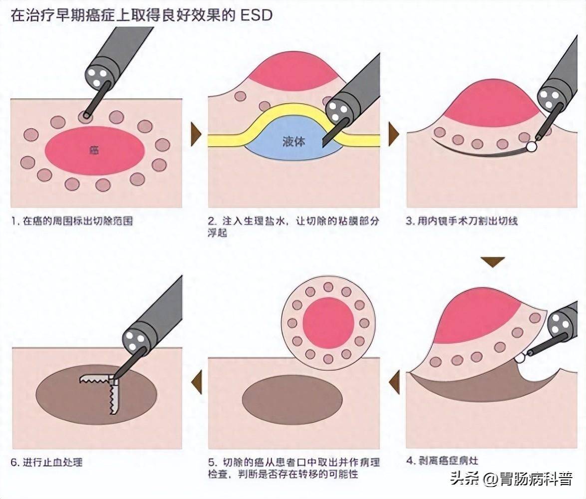 直肠环周切缘示意图图片