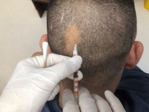 斑秃鬼剃头知多少