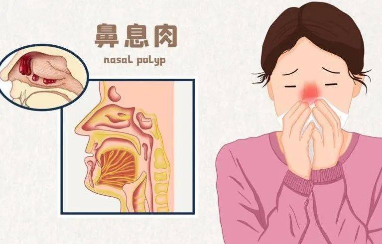 其二是鼻腔黏膜的长期慢性炎症,或鼻窦脓性分泌物的长期刺激,加之细菌