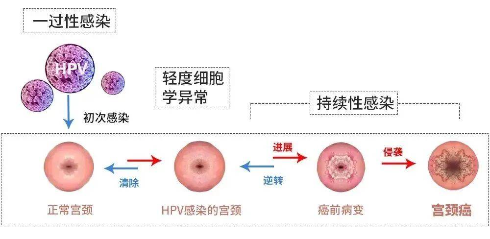 宫颈癌筛查图片怎么看图片