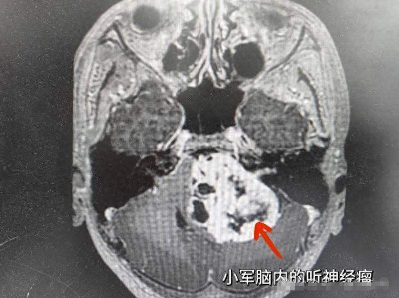 贵阳市第二人民医院成功完成了一例罕见巨大型听神经瘤手术_小军_肿瘤_王诚