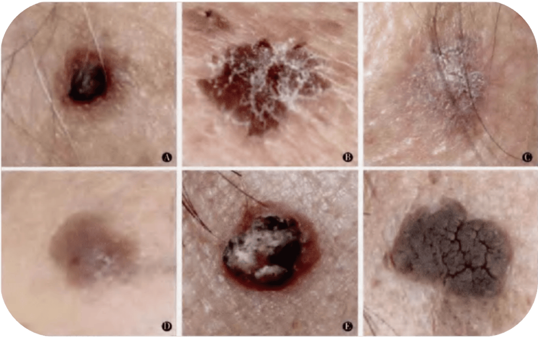 1个月发现6例 这些皮肤癌经常伪装成老年斑