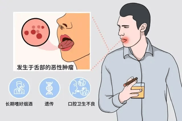 健康科普丨口腔溃烂久治不愈可能发展成舌癌有这些症状需警惕