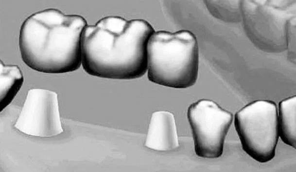 镶假牙哪种材质适合你