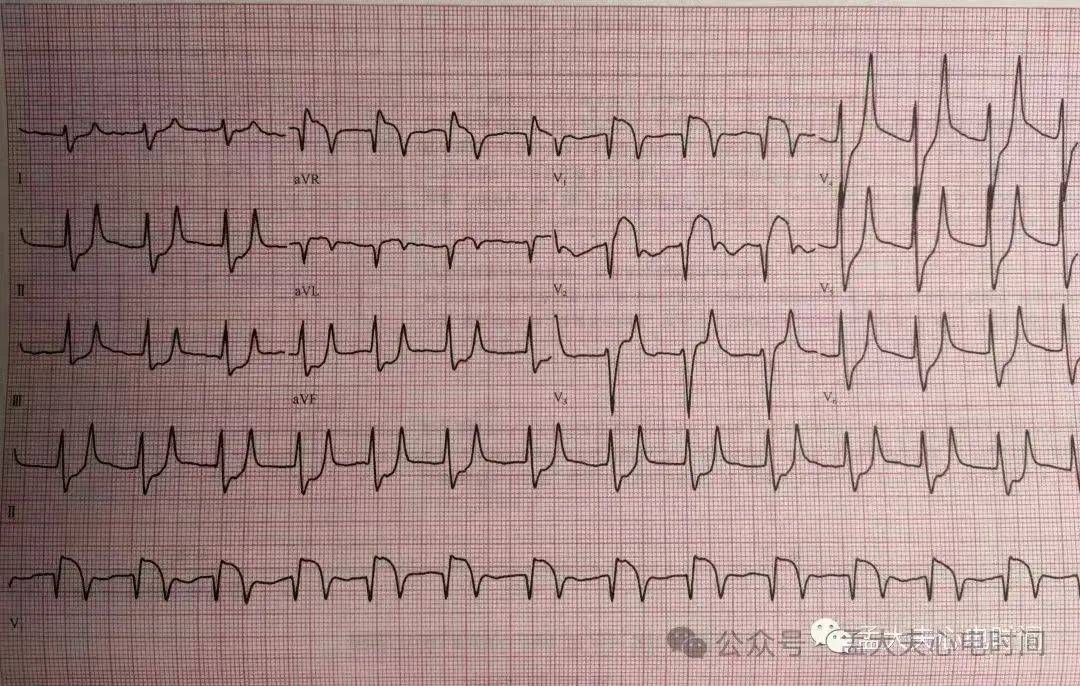 高尖t波心电图表现图片