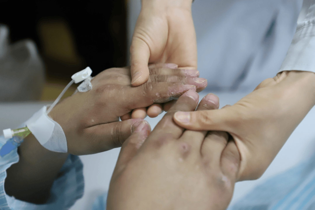 摔跤吧爸爸小芭比塔演员去世年仅19岁她罹患的皮肌炎究竟是怎么回事