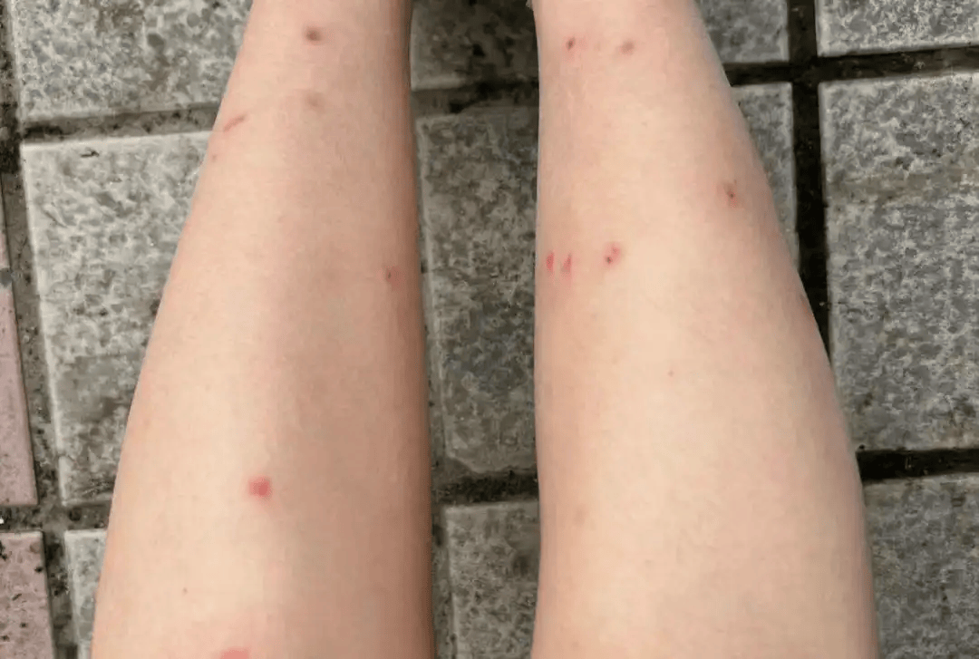 图源:江苏新闻虫咬性皮炎,主要指虫类叮咬,或接触虫的毒液,毒毛而引起
