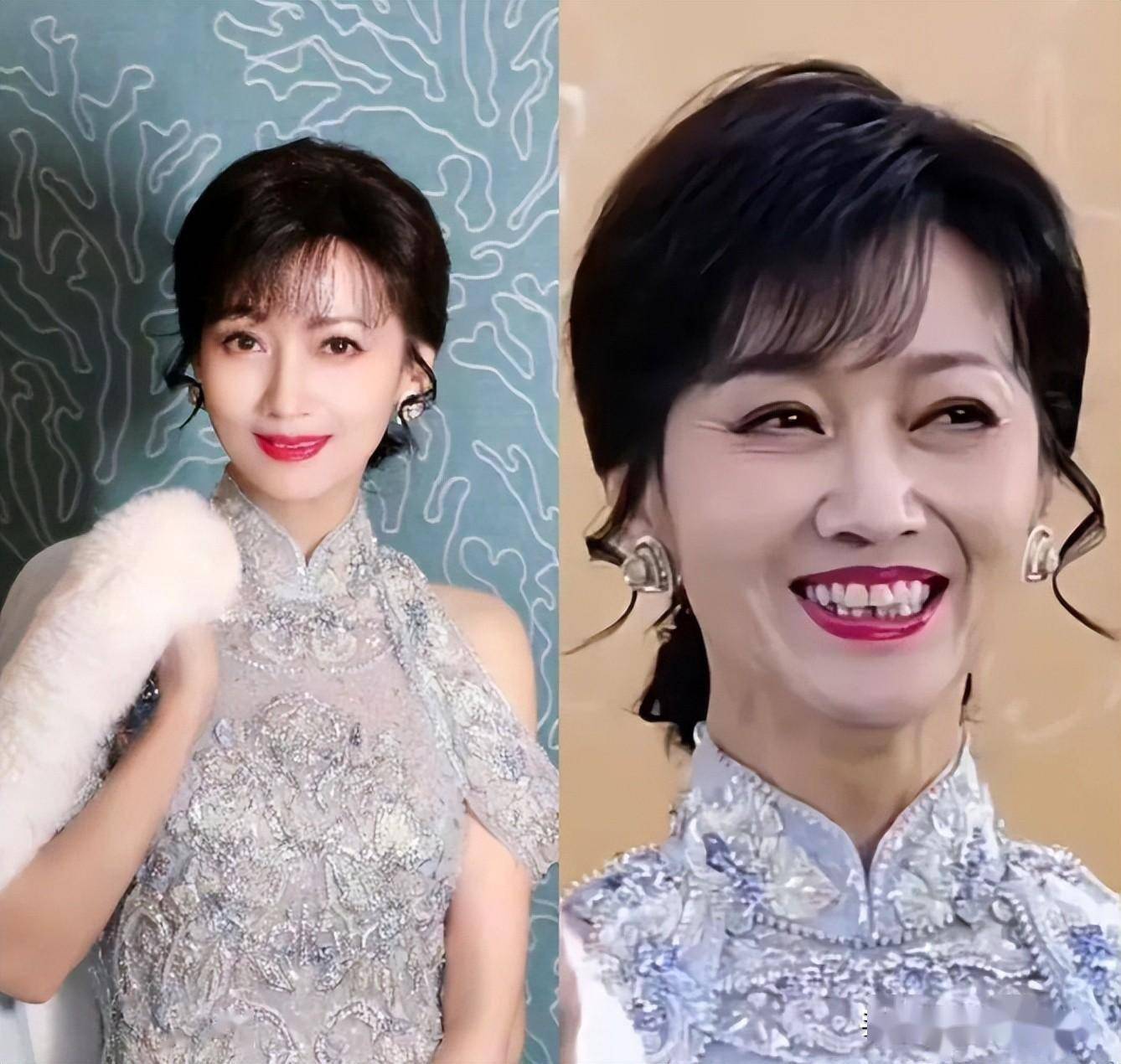 但是赵雅芝后牙下排牙齿的缺失或者是整齐程度差,就会导致面部形态的