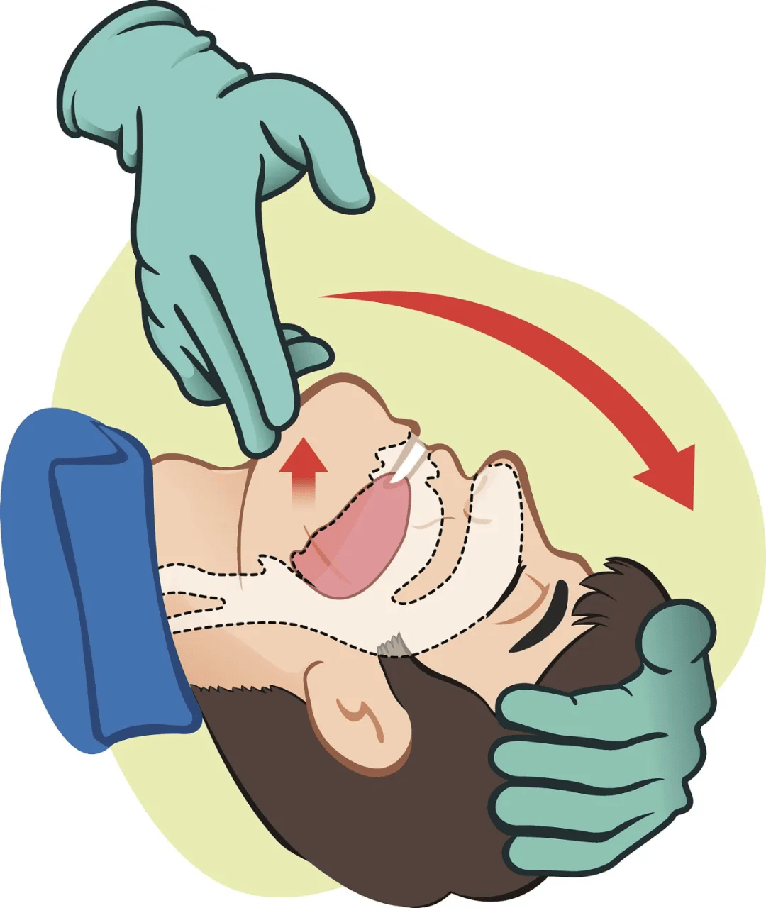 急救科普心肺复苏cpr全攻略