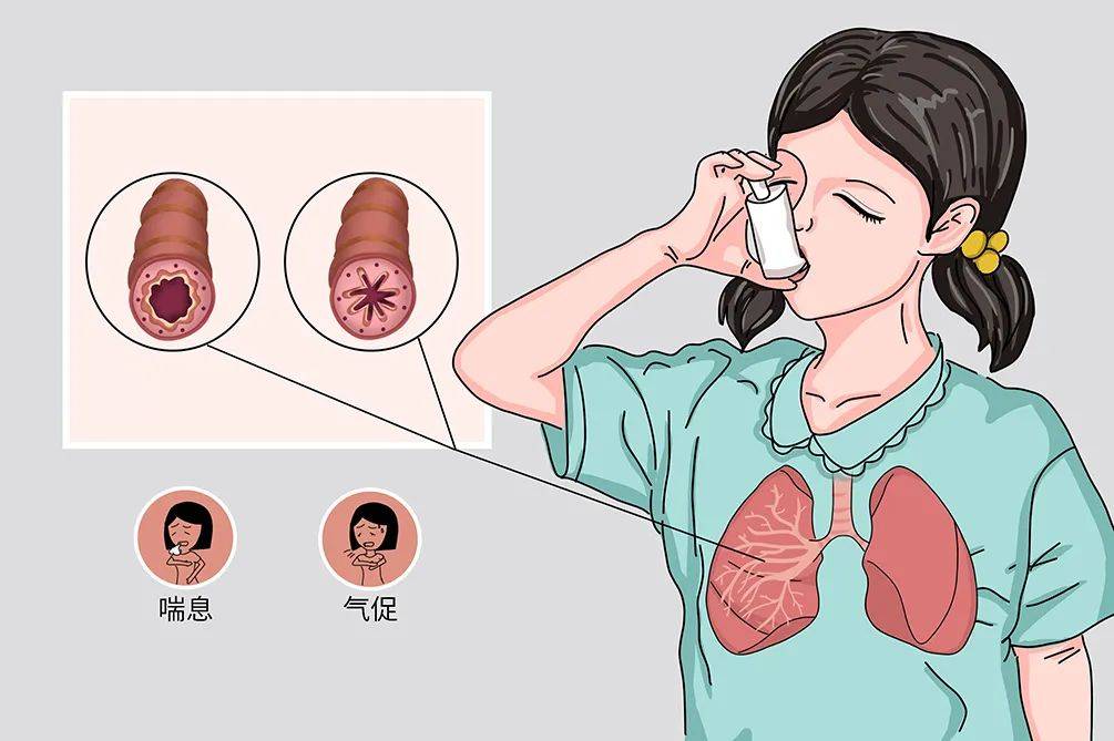 防治哮喘让呼吸更自由